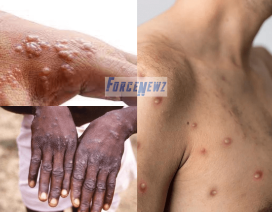 Monkeypox Virus in India